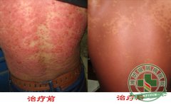 SP-R多維牛皮癬康復體系-西站牛皮癬治療體系